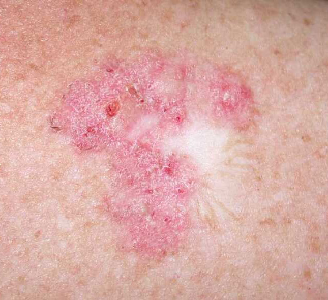 Basal Cell Carcinoma