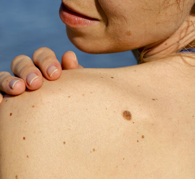 Freckles and Moles