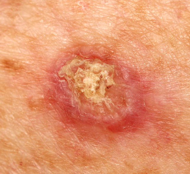 Squamous Cell Carcinoma