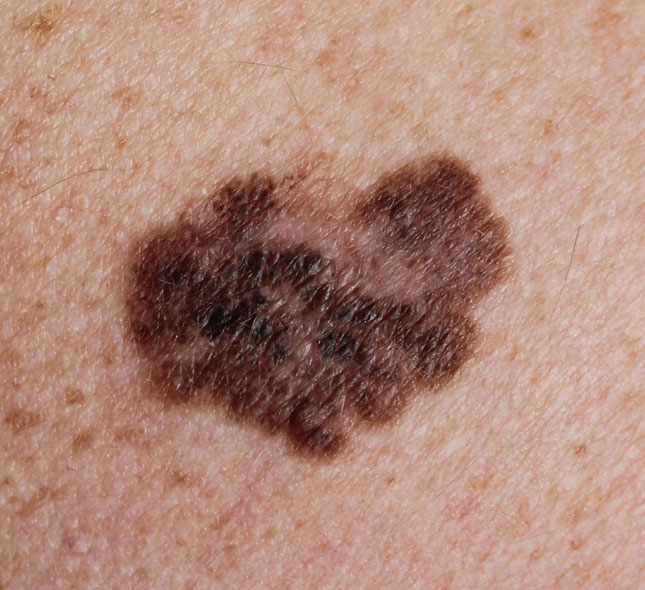 Melanoma